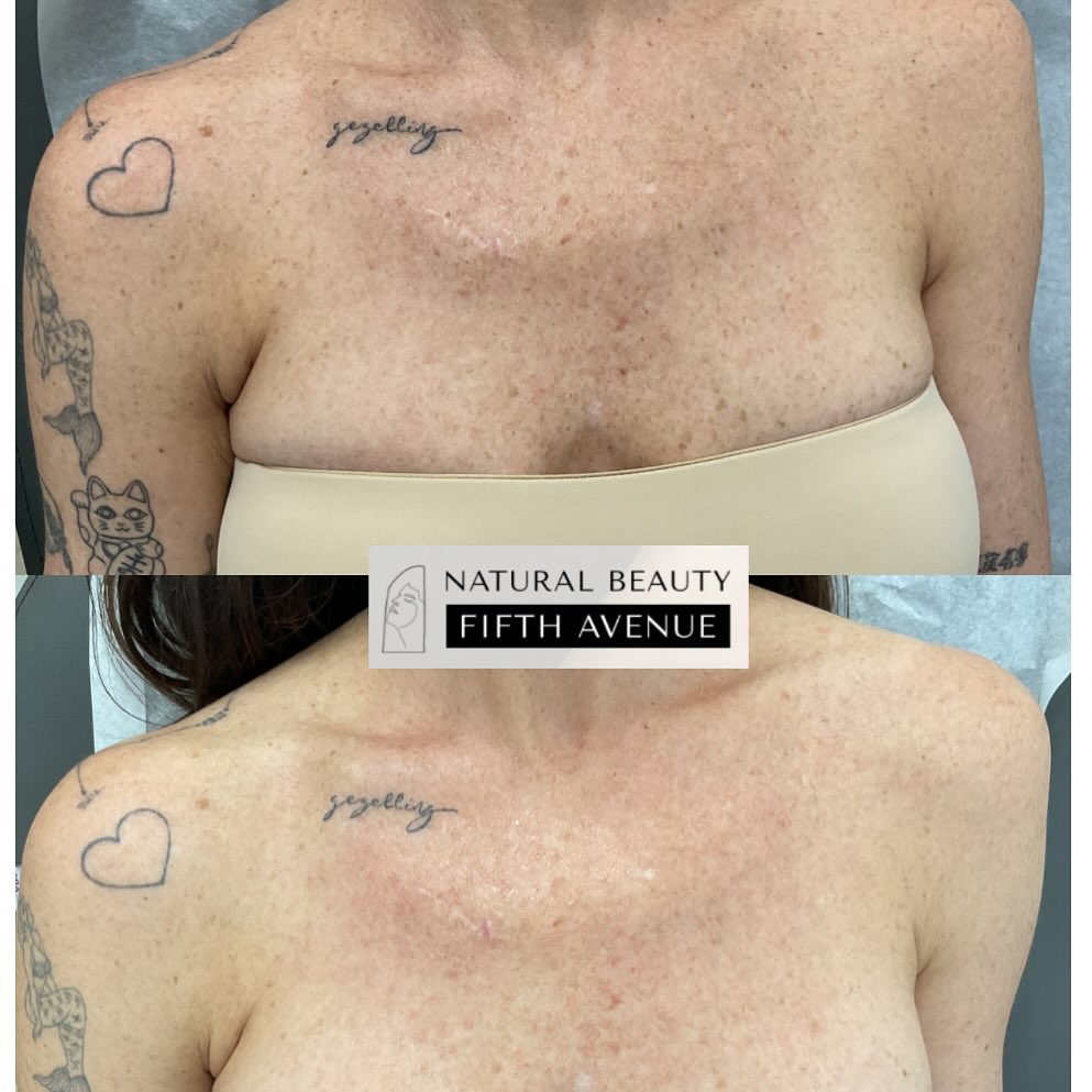 Before and after laser skin resurfacing on chest showing reduced sun damage and improved skin texture